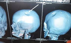 Teacher's Bag Assault Shatters Young Student's Skull